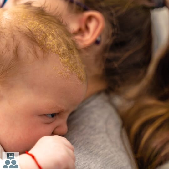 seborroïsch eczeem, baby op de schouder van moeder en heeft seborroïsch eczeem.