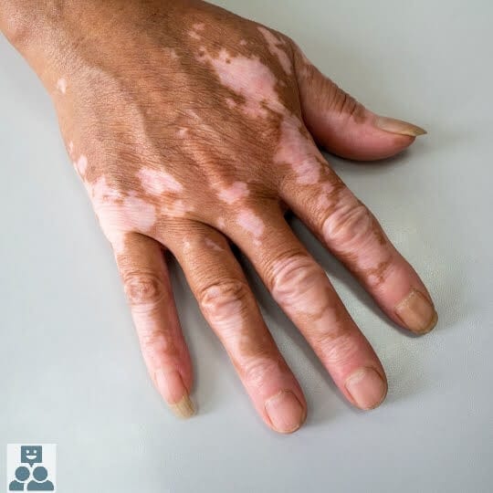 Wereld Vitiligodag, een foto van een hand met de aandoening Vitiligo